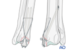 K-wires and tension band fixation
