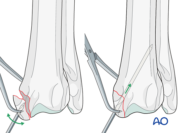 Insertion of the K-wire in the distal fragment that is then used as a joystick to achieve reduction