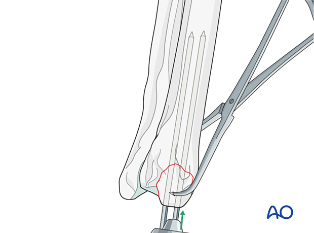 Normograde insertion of a single K-wire from the radial styloid process across the fracture line into the proximal fragment
