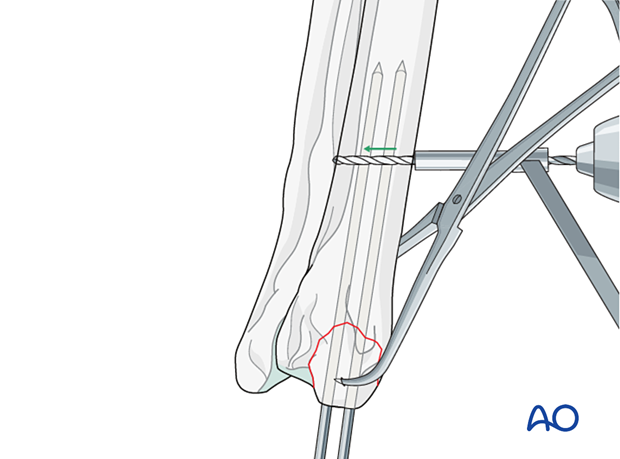 Drilling a small hole from cranial to caudal in the proximal fragment