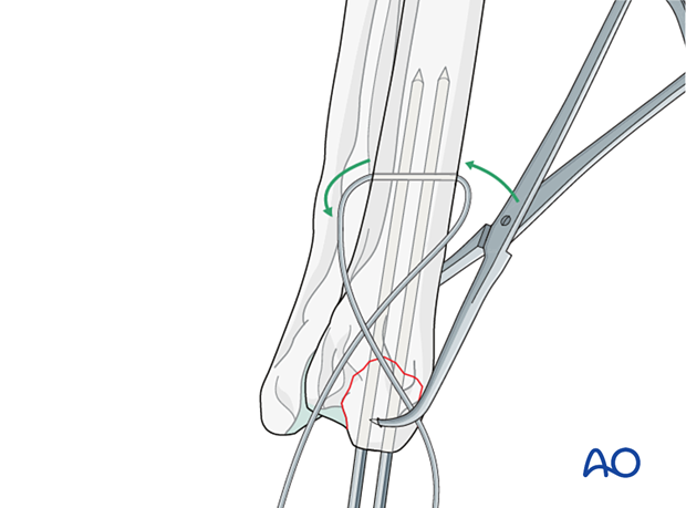 Insertion of the tension band wire through the hole and crossing of the ends on the medial surface of the radius