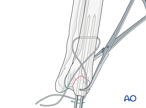 Passing the wire around the ends of the K-wire in a figure-of-eight fashion