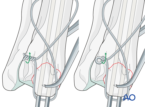 Use of twist knots for tension band wires