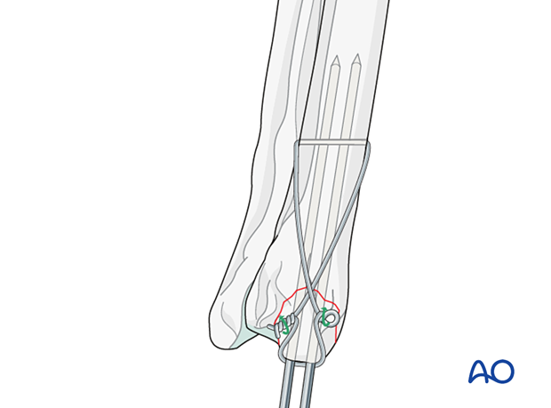 Tightening the tension band wire by twisting the two knots