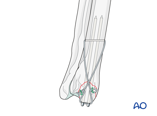 Position of the wire is set and tightening of the figure-of-eight is completed