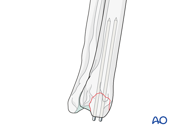 Two K-wires without a tension band wire can be an option when combined with a splinted bandage