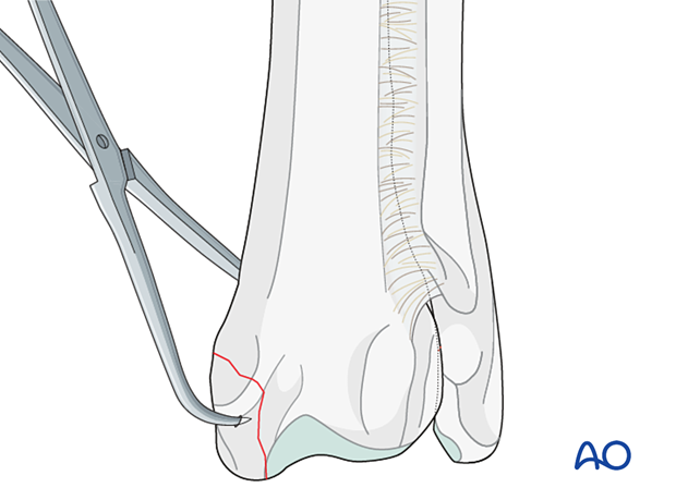 Pointed reduction forceps placed across the fracture line to obtain anatomical reduction