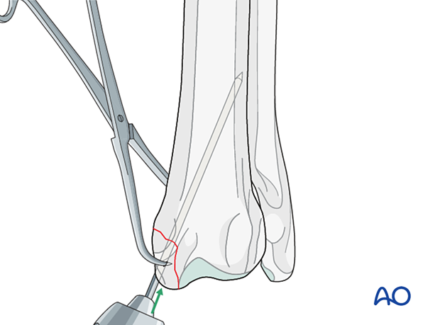 Normograde insertion of a single K-wire from the radial styloid process across the fracture line into the proximal fragment
