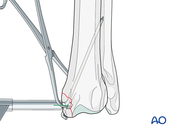 Drilling a small hole from the radial styloid process to the fracture line