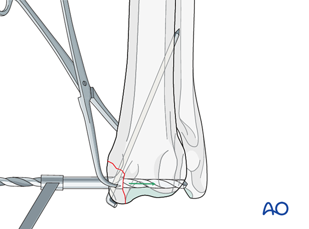 Drilling a hole into the lateral cortex of the proximal fragment