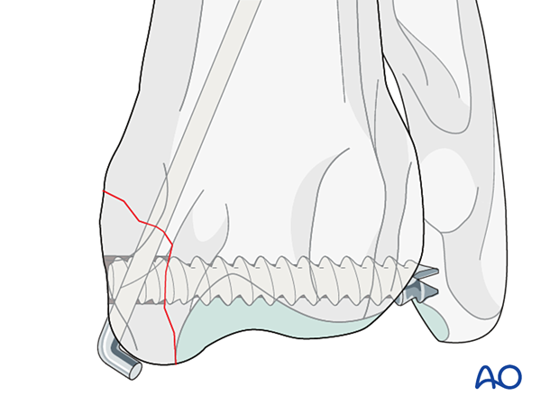 Placing the guide wire in the position of the proposed screw
