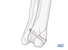 Lag screw fixation