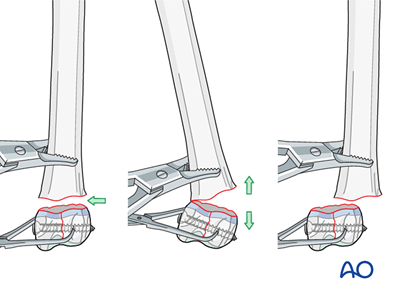 Lag screw and K-wire fixation for Simple complete articular fracture of ...
