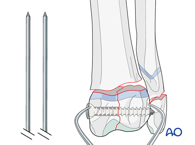 Lag screw and K-wire fixation for Simple complete articular fracture of ...