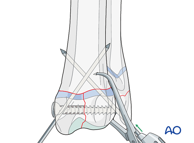 Lag screw and K-wire fixation for Simple complete articular fracture of ...