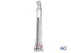 Lag screw and bridging plate fixation