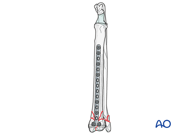 D23_P190_i020 Lag screw and bridging plate fixation of 23-C2 fractures
