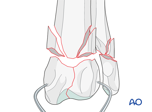 D23_P190_i060 Pointed reduction forceps placed from medial to lateral in the epiphyseal fragments to obtain anatomical reduction of the articular fracture line
