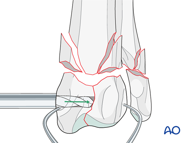 D23_P190_i100 Drilling a hole from the styloid process of the radius to the fracture line in medial to lateral direction