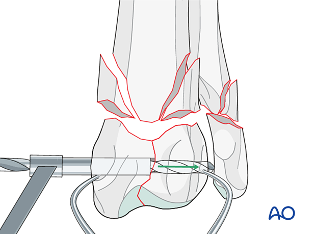 D23_P190_i120 Insertion of an appropriately sized drill guide to drill a hole into the lateral cortex of the epiphysis