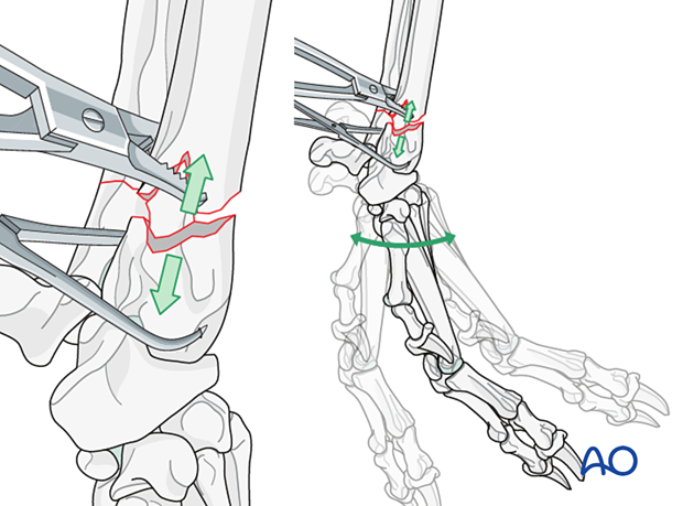 D23_P190_i150 Distraction and alignment of the major bone segments using bone-holding forceps to achieve indirect reduction