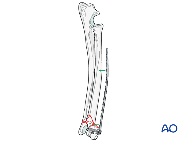 D23_P190_i160 Fixation of the plate in the distal fragment first to achieve reduction on the proximal fragment