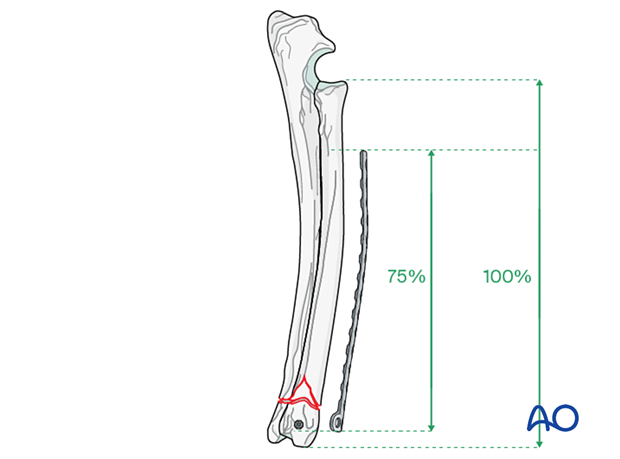 D23_P190_i180 Plate should bridge at least 75% of the length of the radius