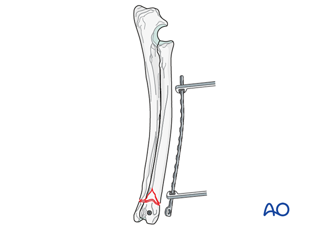 D23_P190_i200 Appropriately sized plate is contoured to fit the distal radius