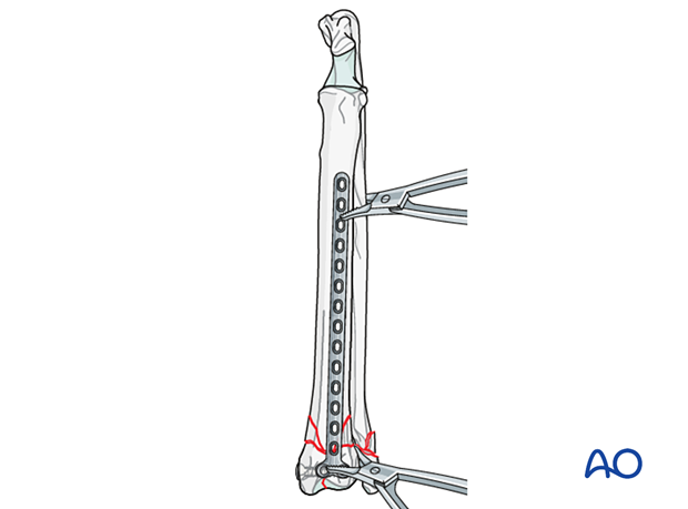 D23_P190_i220 Application of the T-plate on the cranial surface of the distal radius
