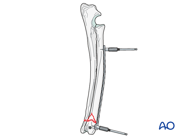 D23_P190_i280 Insertion of a push-pull device instead of plate-holding forceps in the proximal and distal fragment if a locking compression plate is used