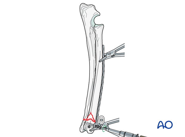 D23_P190_i300 Insertion of the first two screws in neutral position in the distal fragment