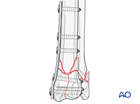 Lag screw and medial bridging plate fixation