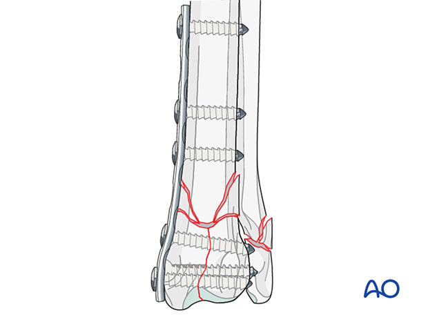 Lag screw and medial bridging plate fixation of 23-C2 fractures