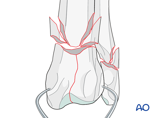 Sliding the bone fragments along the fracture line into anatomical reduction using pointed reduction forceps