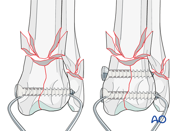 Securing the oblique fracture with lag screws