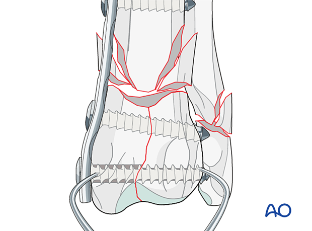 Fixation of the fracture with lag screws inserted through the bridging plate if the plate is applied on the medial side