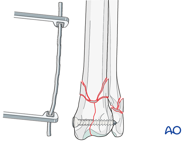 Meticulous contouring of the nonlocking plate to avoid fragment displacement and loss of reduction
