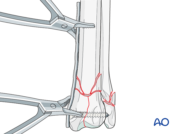 Application of the contoured plate on the medial surface of the distal radius and securing it with plate-holding forceps