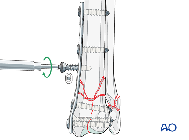 Insertion of the screw in neutral mode and not close to or at the level of the fracture line