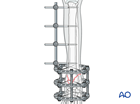 Pancarpal arthrodesis with external skeletal fixation