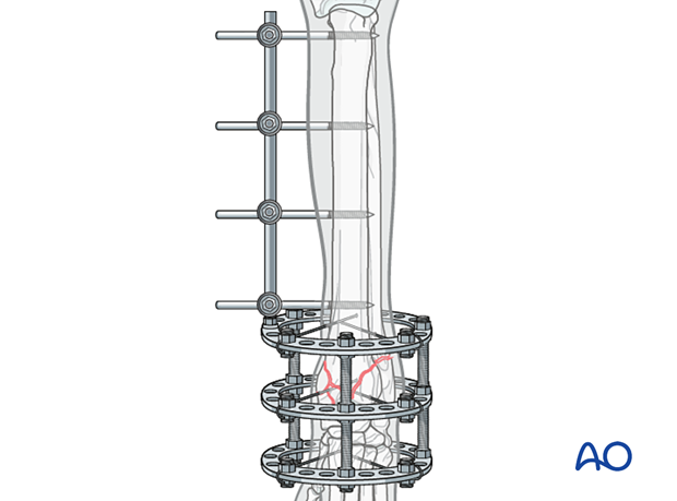 D23_P205_i020 Pancarpal arthrodesis with a circular or hybrid external skeletal fixator for arthrodesis of a nonreconstructable joint fracture