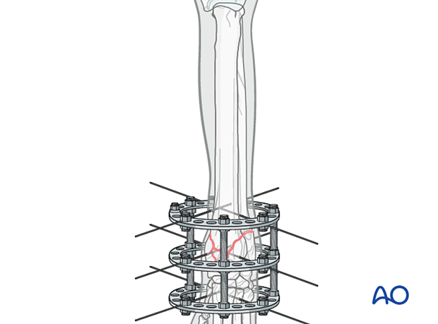D23_P205_i025 Ring fixator with additional ring(s) distally below the carpus