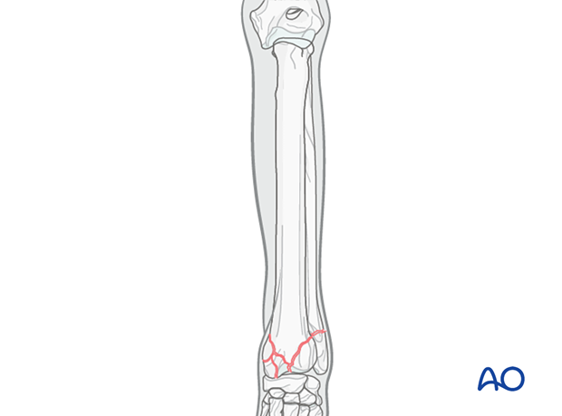 D23_P205_i040 Maintaining functional alignment of the limb during stabilization