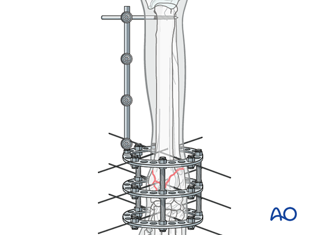 D23_P205_i100 Ring fixator with a hybrid connector rod coupled to the ring on the medial side and three to four clamps placed on the connector rod