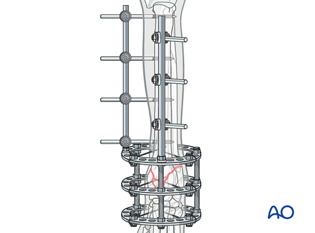 D23_P205_i180 Adding a craniocaudal connector bar with two to three threaded half-pins in the proximal segment may be required for additional stability
