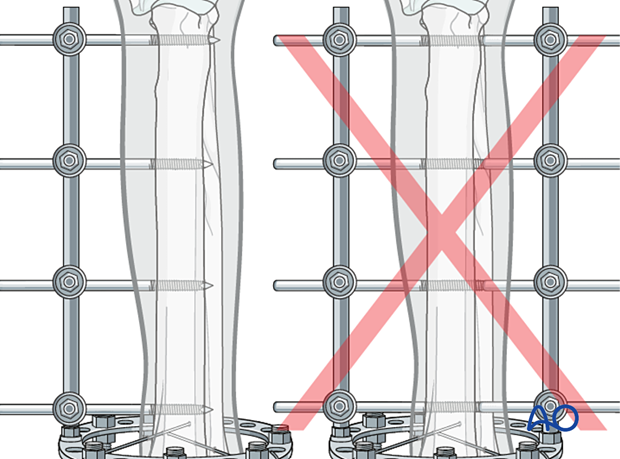 D23_P205_i200 Threaded full pins should only be used when the need for mechanical stability outweighs the anticipated soft-tissue morbidity