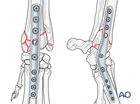 Pancarpal arthrodesis with a plate