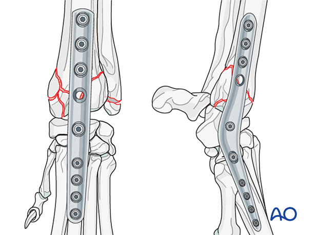 D23_P210_i020 Pancarpal arthrodesis with a plate for nonreconstructable articular fractures of the distal radius