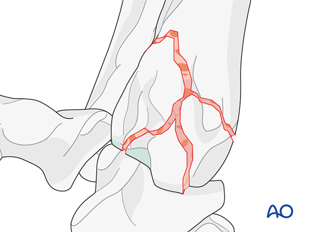 D23_P210_i080 Distributing bone graft well in each aspect of the antebrachiocarpal joint