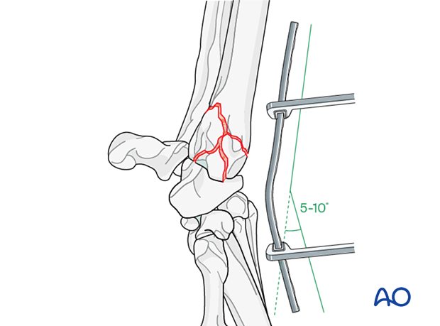 D23_P210_i120 Contouring of an appropriately sized plate to provide 5β10 degrees of extension of the radiocarpal joint